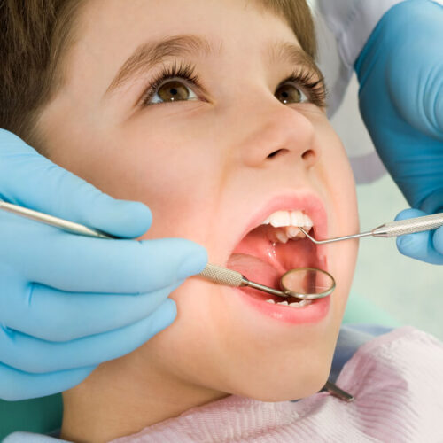 Przebarwienia zębów u dzieci – przyczyny